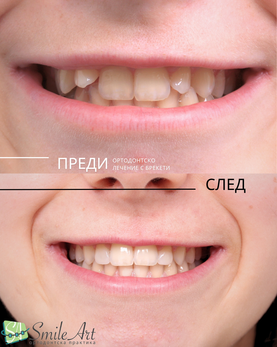 Ортодонтско лечение при микродонтия (зъби с малък размер)
