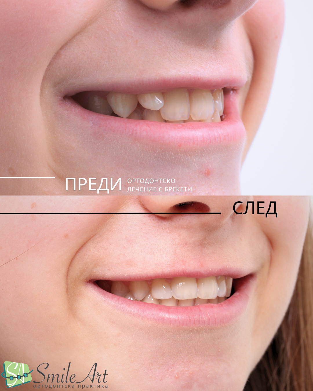 Ортодонтско лечение при микродонтия (зъби с малък размер)
