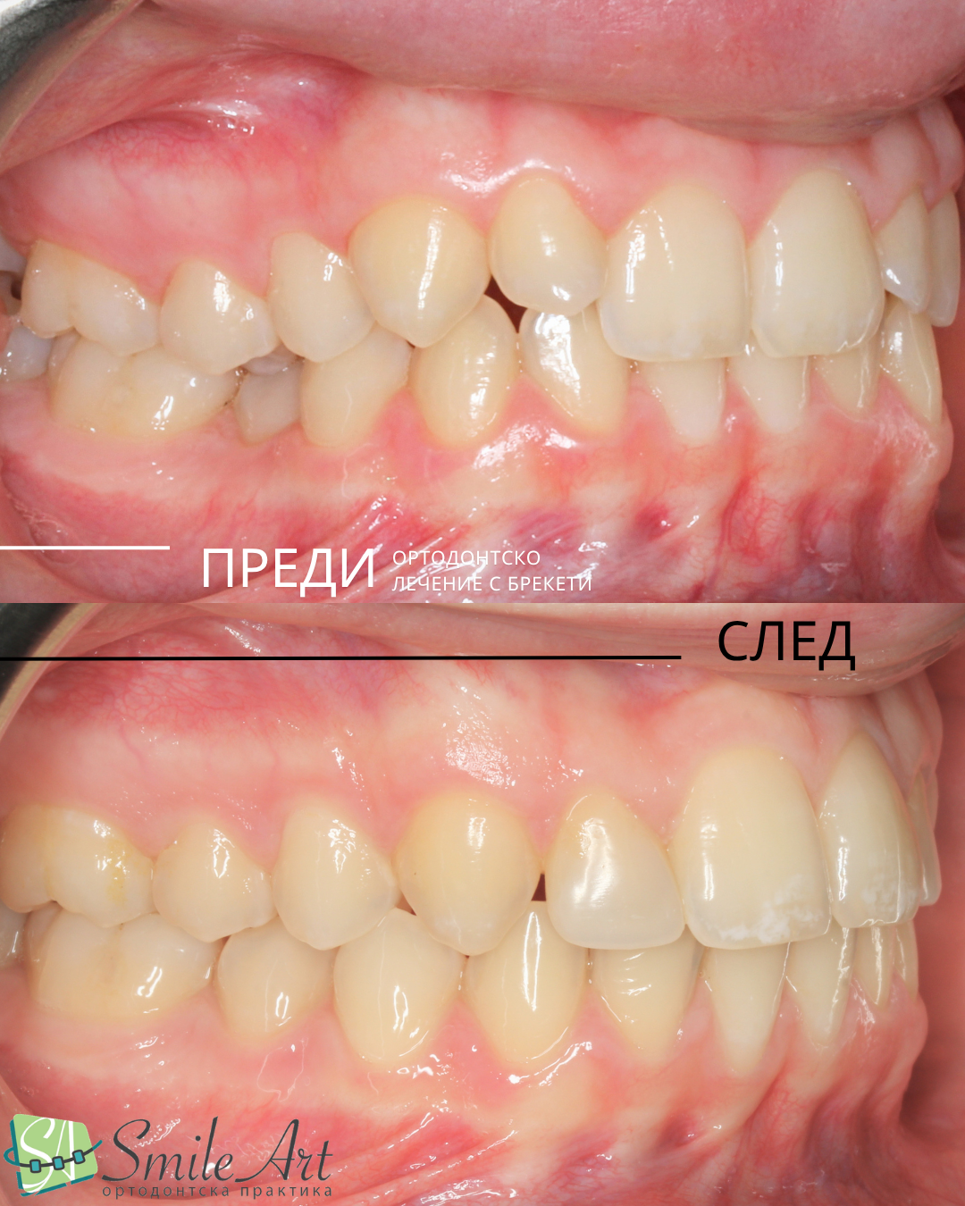 Ортодонтско лечение при микродонтия (зъби с малък размер)